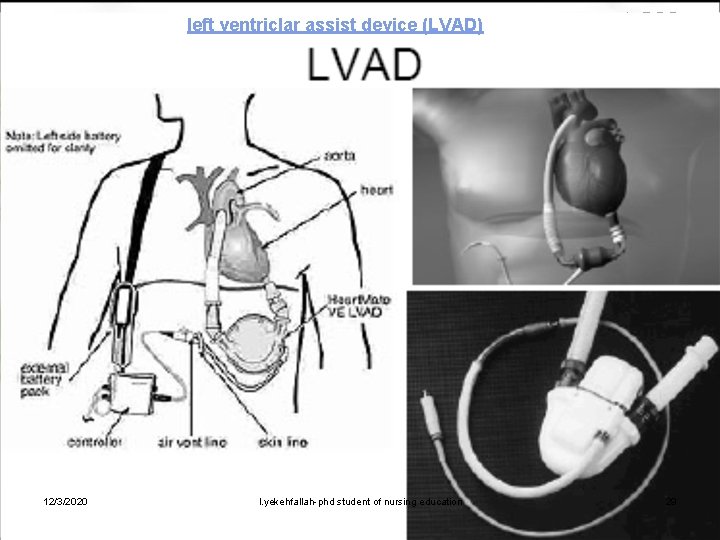 left ventriclar assist device (LVAD) 12/3/2020 l. yekehfallah-phd student of nursing education 29 