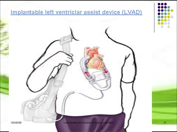 Implantable left ventriclar assist device (LVAD) 12/3/2020 l. yekehfallah-phd student of nursing education 31