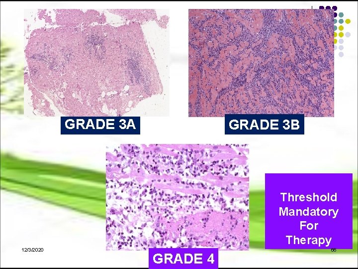 GRADE 3 A GRADE 3 B Threshold Mandatory For Therapy 12/3/2020 GRADE 4 66