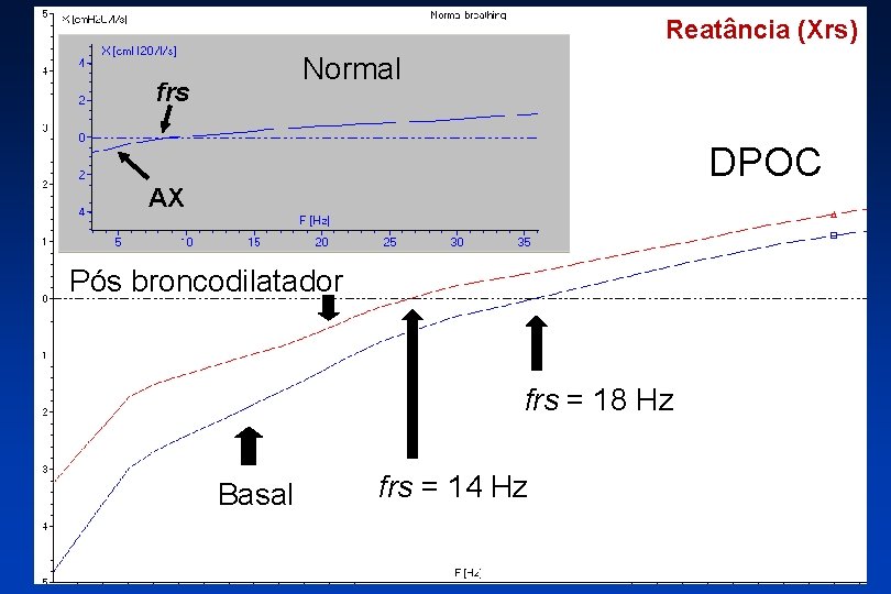 Reatância (Xrs) Normal frs DPOC AX Pós broncodilatador frs = 18 Hz Basal frs