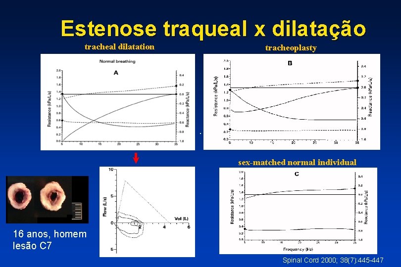 Estenose traqueal x dilatação tracheal dilatation tracheoplasty sex-matched normal individual 16 anos, homem lesão