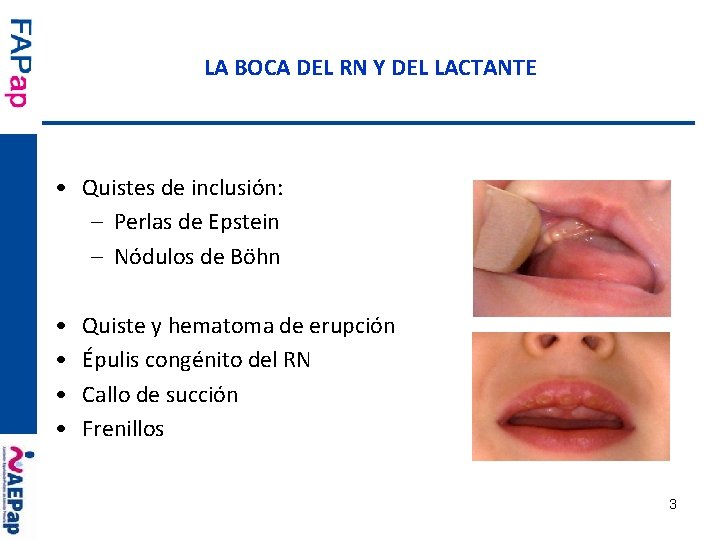 LA BOCA DEL RN Y DEL LACTANTE • Quistes de inclusión: – Perlas de