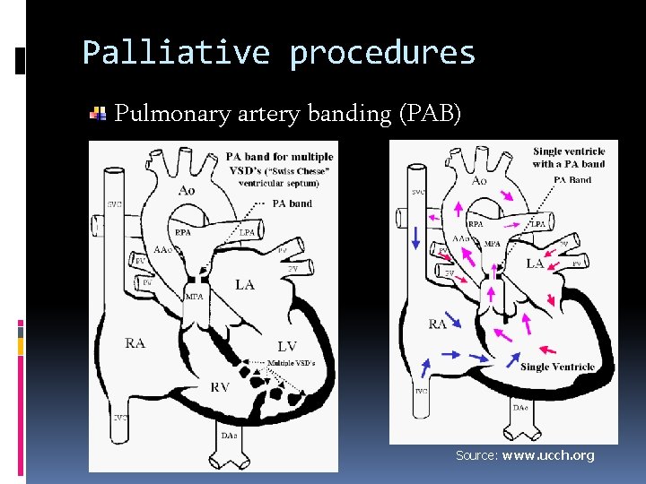 Palliative procedures Pulmonary artery banding (PAB) Source: www. ucch. org 