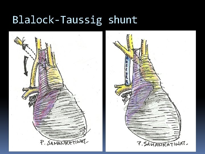 Blalock-Taussig shunt 