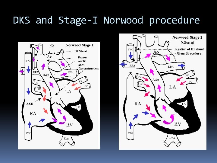 DKS and Stage-I Norwood procedure 