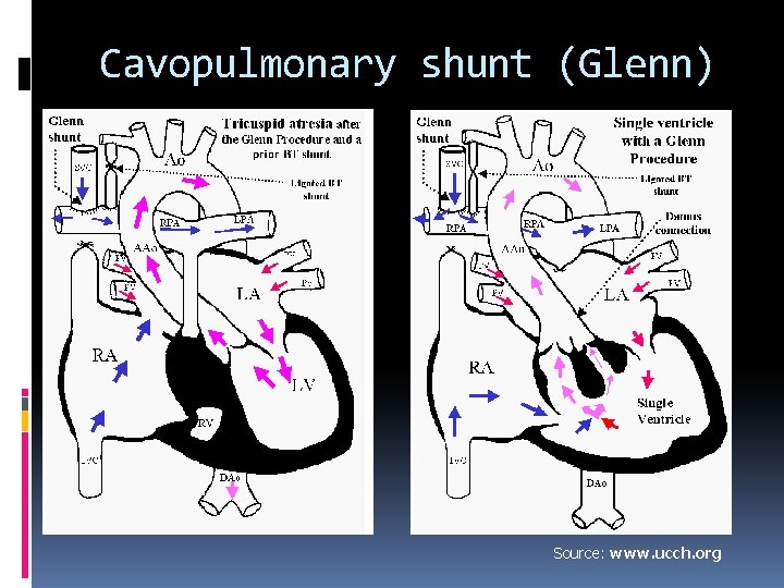 Cavopulmonary shunt (Glenn) Source: www. ucch. org 