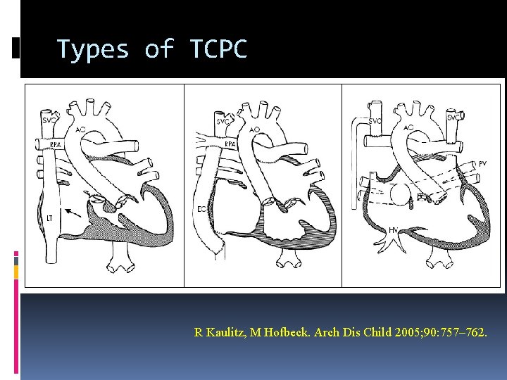 Types of TCPC R Kaulitz, M Hofbeck. Arch Dis Child 2005; 90: 757– 762.