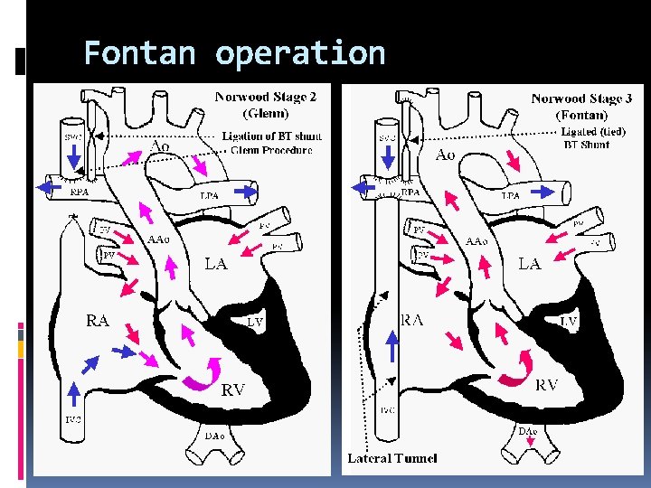 Fontan operation 