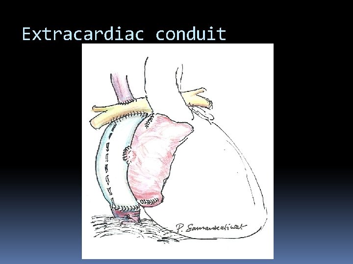 Extracardiac conduit 