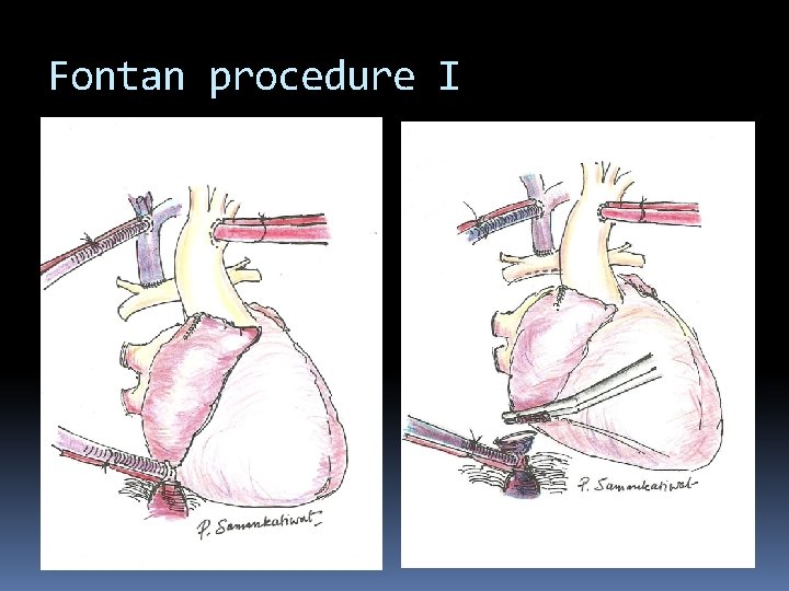 Fontan procedure I 