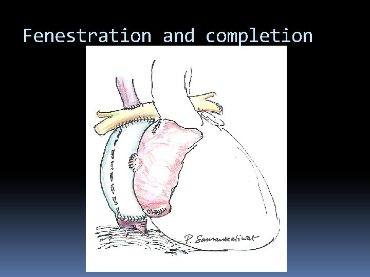 Fenestration and completion 