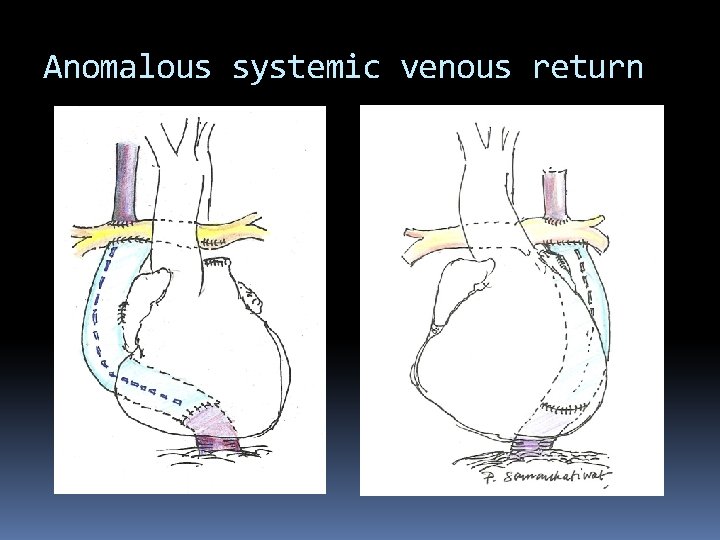 Anomalous systemic venous return 