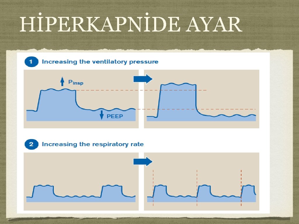 HİPERKAPNİDE AYAR 