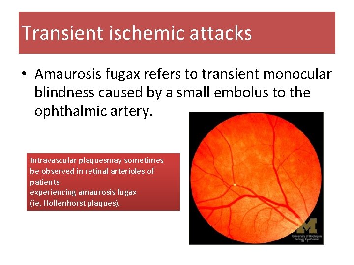 Transient ischemic attacks • Amaurosis fugax refers to transient monocular blindness caused by a