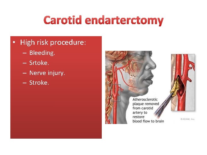 Carotid endarterctomy • High risk procedure: – – Bleeding. Srtoke. Nerve injury. Stroke. 