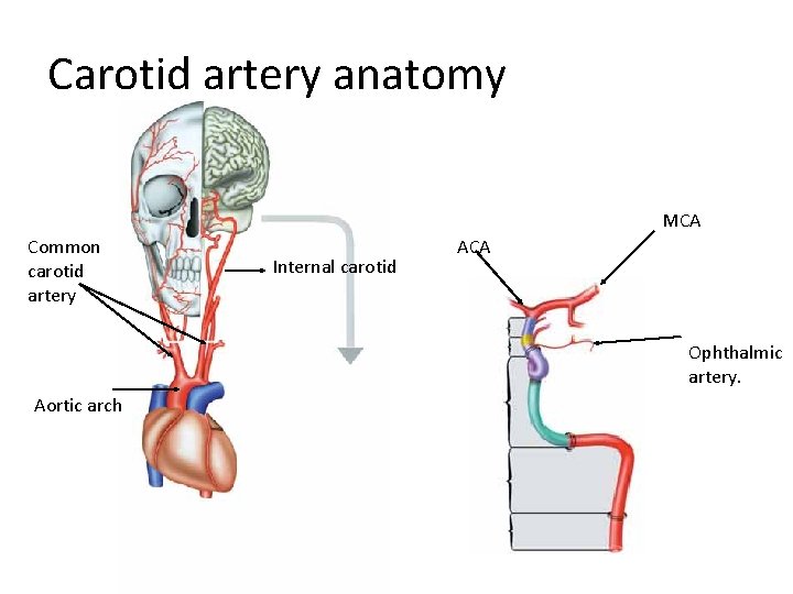 Carotid artery anatomy MCA Common carotid artery Internal carotid ACA Ophthalmic artery. Aortic arch