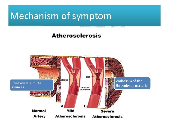 Mechanism of symptom low-flow due to the stenosis embolism of the thrombotic material 