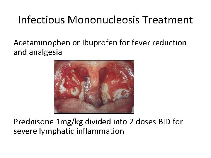 Infectious Mononucleosis Treatment Acetaminophen or Ibuprofen for fever reduction and analgesia Prednisone 1 mg/kg