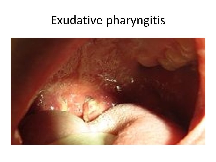 Exudative pharyngitis 