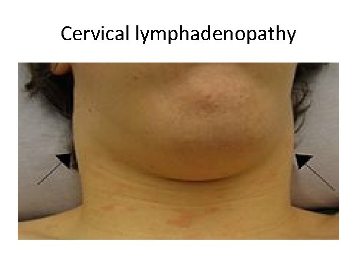 Cervical lymphadenopathy 