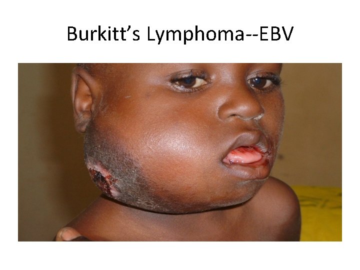 Burkitt’s Lymphoma--EBV 