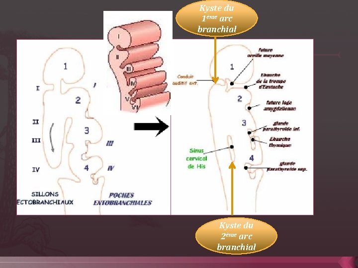 Kyste du 1ème arc branchial Kyste du 2ème arc branchial 