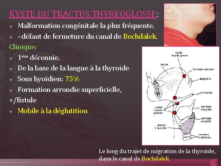 KYSTE DU TRACTUS THYREOGLOSSE: Malformation congénitale la plus fréquente. v =défaut de fermeture du