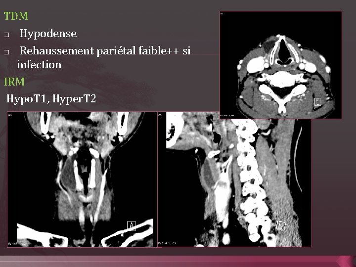 TDM � Hypodense � Rehaussement pariétal faible++ si infection IRM Hypo. T 1, Hyper.