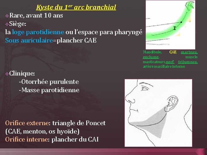 Kyste du 1 er arc branchial v. Rare, avant 10 ans v. Siège: la