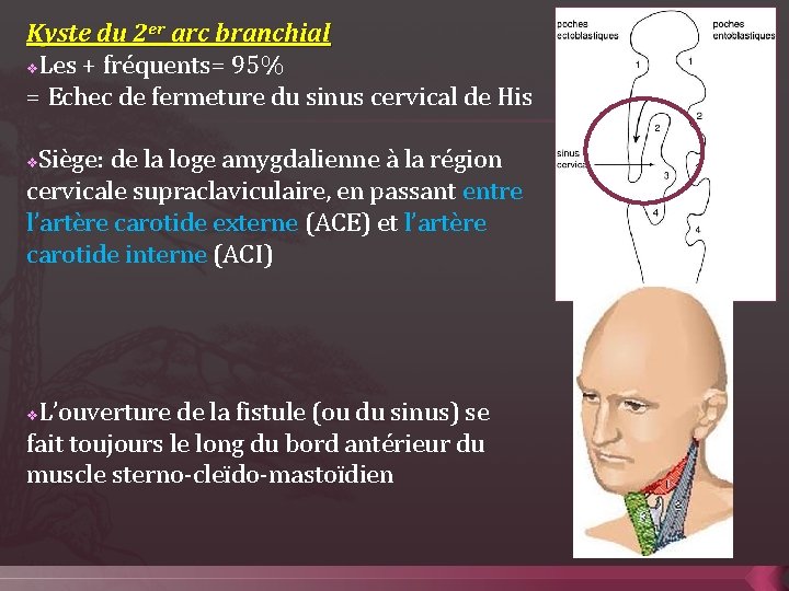 Kyste du 2 er arc branchial v. Les + fréquents= 95% = Echec de