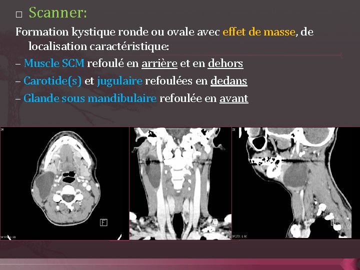 � Scanner: Formation kystique ronde ou ovale avec effet de masse, de localisation caractéristique: