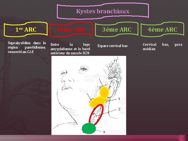 Kystes branchiaux 1 er ARC Suprahyoïdien dans la région parotidienne, connecté au CAE 2ème