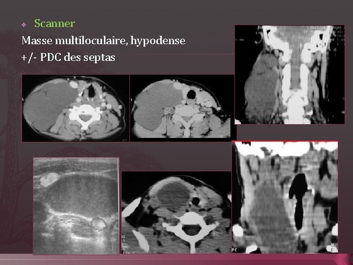 Scanner Masse multiloculaire, hypodense +/- PDC des septas v 