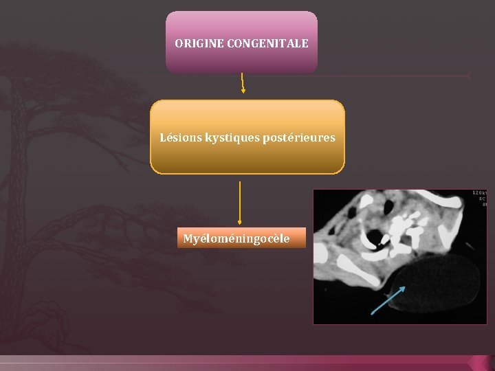 ORIGINE CONGENITALE Lésions kystiques postérieures Myéloméningocèle 