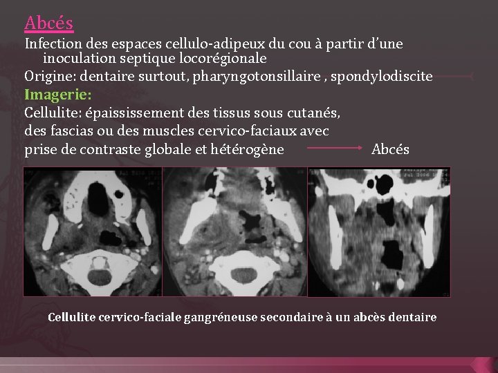 Abcés Infection des espaces cellulo-adipeux du cou à partir d’une inoculation septique locorégionale Origine: