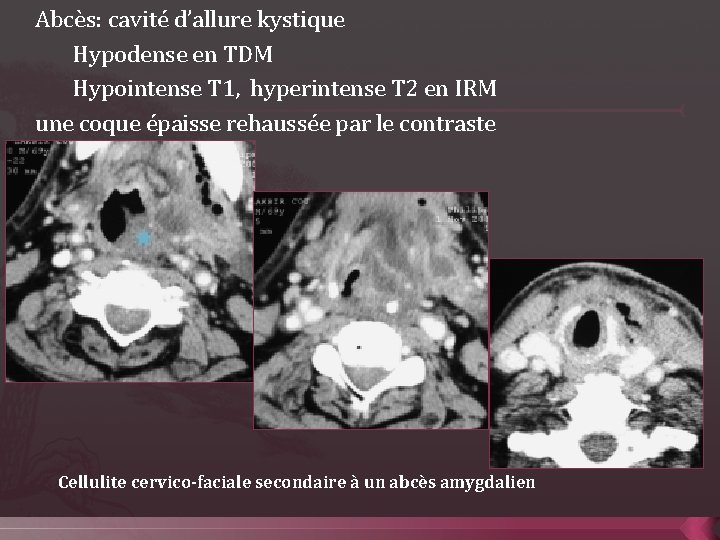 Abcès: cavité d’allure kystique Hypodense en TDM Hypointense T 1, hyperintense T 2 en