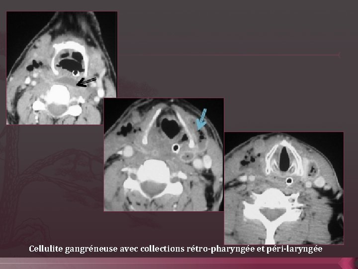 Cellulite gangréneuse avec collections rétro-pharyngée et péri-laryngée 