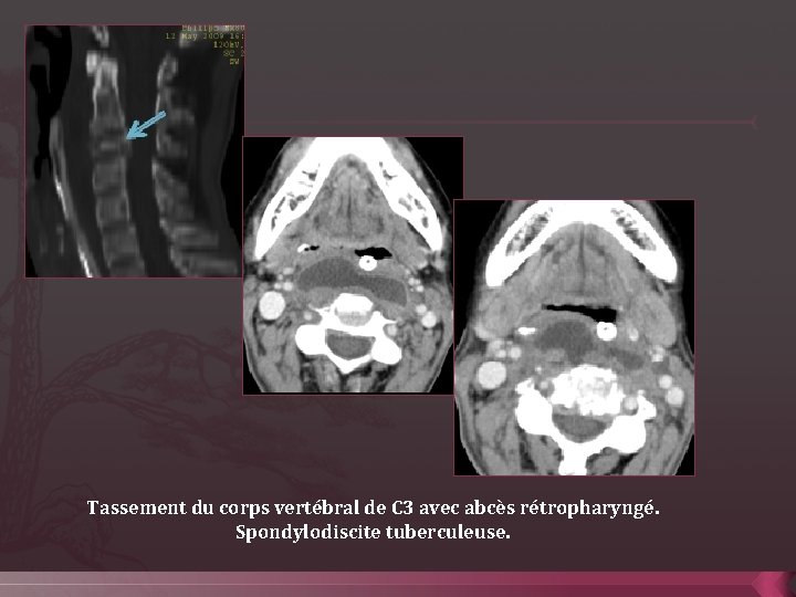 Tassement du corps vertébral de C 3 avec abcès rétropharyngé. Spondylodiscite tuberculeuse. 