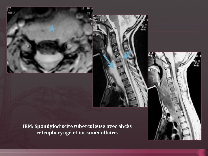 IRM: Spondylodiscite tuberculeuse avec abcès rétropharyngé et intramédullaire. 
