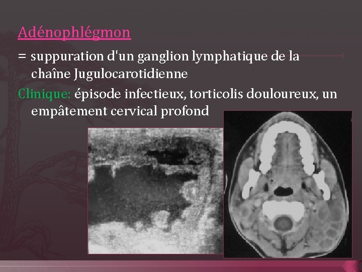 Adénophlégmon = suppuration d'un ganglion lymphatique de la chaîne Jugulocarotidienne Clinique: épisode infectieux, torticolis