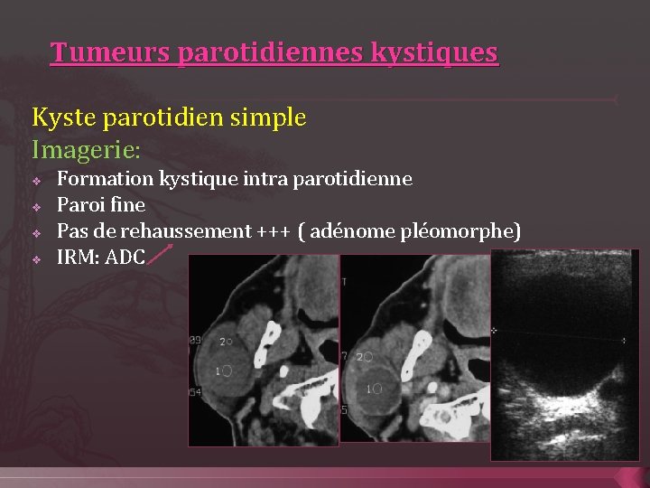 Tumeurs parotidiennes kystiques Kyste parotidien simple Imagerie: v v Formation kystique intra parotidienne Paroi