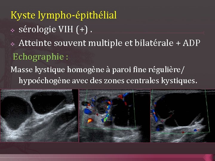 Kyste lympho-épithélial sérologie VIH (+). v Atteinte souvent multiple et bilatérale + ADP Echographie