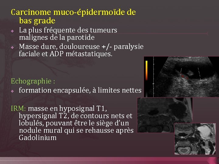 Carcinome muco-épidermoïde de bas grade v v La plus fréquente des tumeurs malignes de