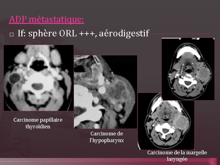 ADP métastatique: � If: sphère ORL +++, aérodigestif Carcinome papillaire thyroïdien Carcinome de l’hypopharynx