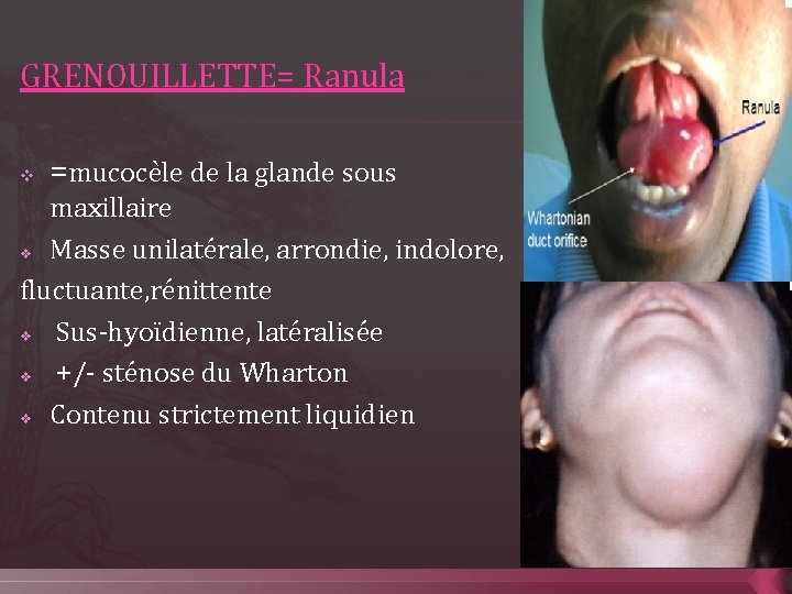 GRENOUILLETTE= Ranula v =mucocèle de la glande sous maxillaire v Masse unilatérale, arrondie, indolore,