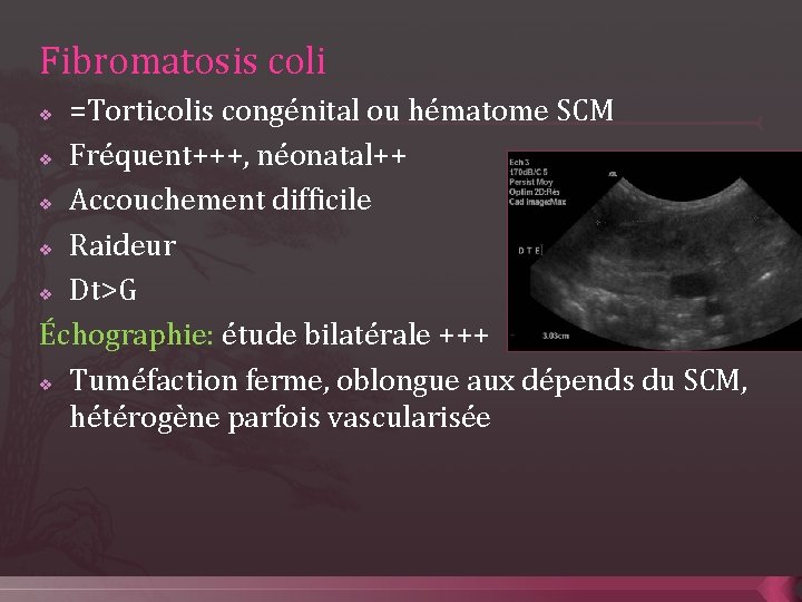 Fibromatosis coli =Torticolis congénital ou hématome SCM v Fréquent+++, néonatal++ v Accouchement difficile v