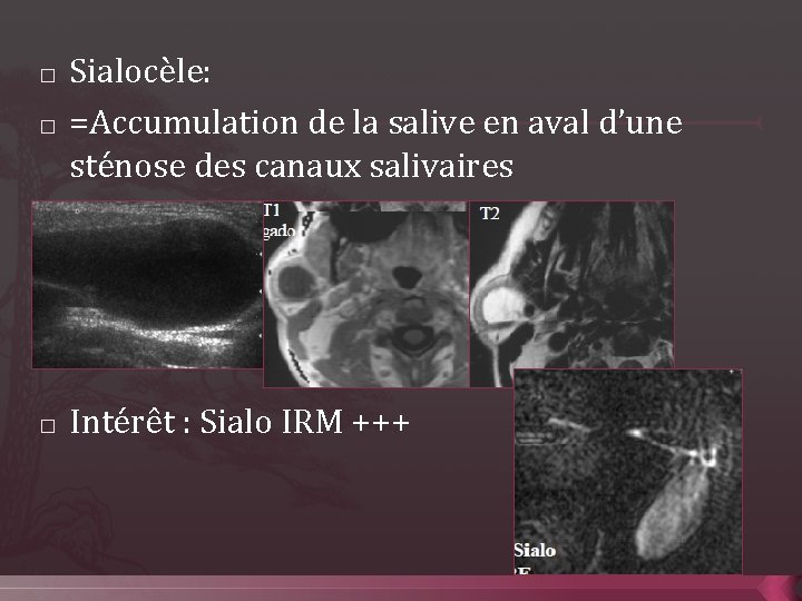 � � � Sialocèle: =Accumulation de la salive en aval d’une sténose des canaux