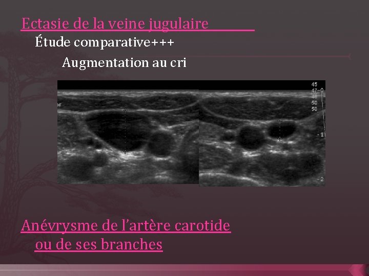 Ectasie de la veine jugulaire Étude comparative+++ Augmentation au cri Anévrysme de l’artère carotide