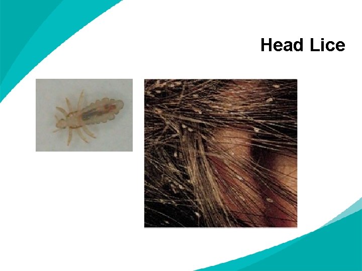 Head Lice 