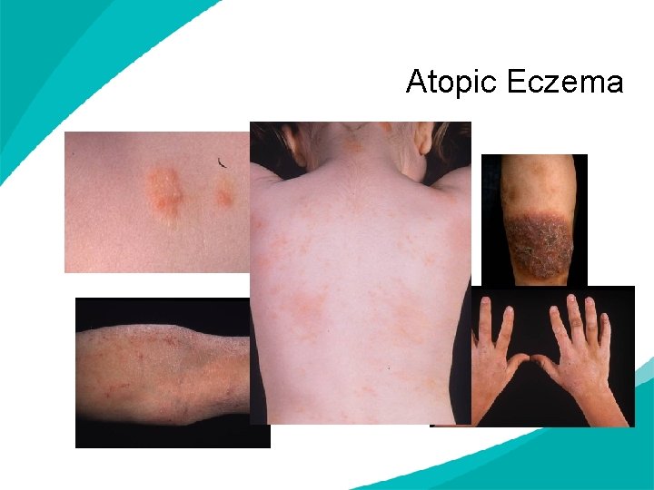 Atopic Eczema 